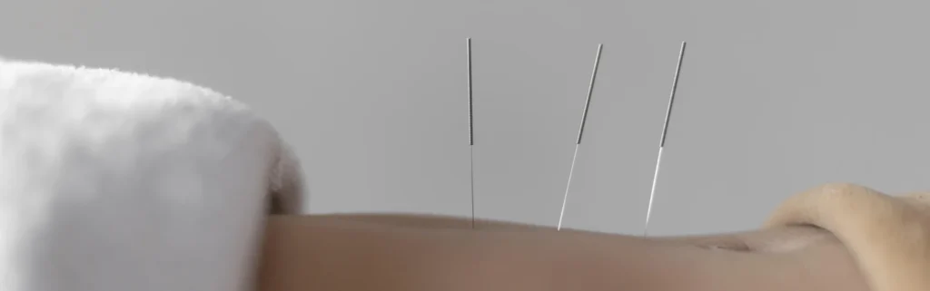 Close up Acupuncture procedure Long Island